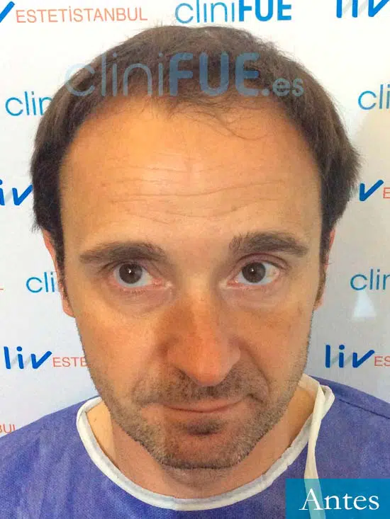 Miguel Ángel 42 Madrid trasplante capilar turquia antes 