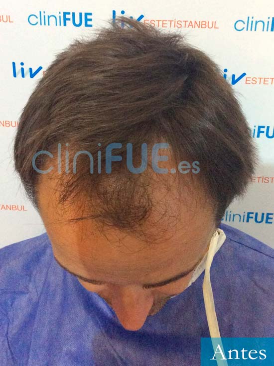 Miguel Ángel 42 Madrid trasplante capilar turquia antes 2