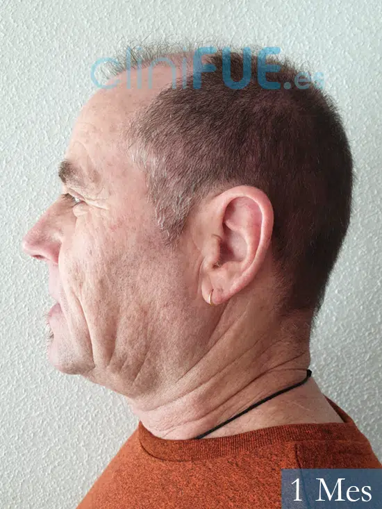 Santos 56 -Navarro trasplante capilar turquia 1 mes 5