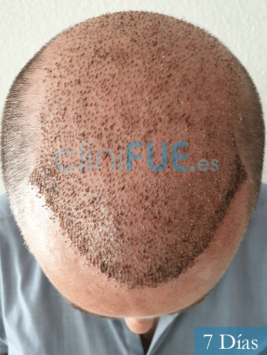 Santos 56 -Navarro trasplante capilar turquia 7 dias 4