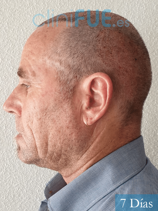 Santos 56 -Navarro trasplante capilar turquia 7 dias 5