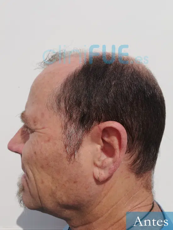Santos 56 Navarro trasplante capilar turquia antes 4