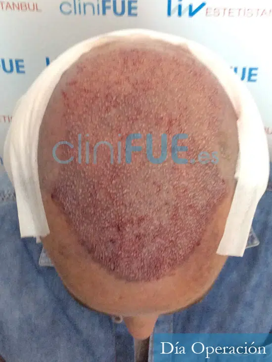 Santos 56 -Navarro trasplante capilar turquia dia operacion 2