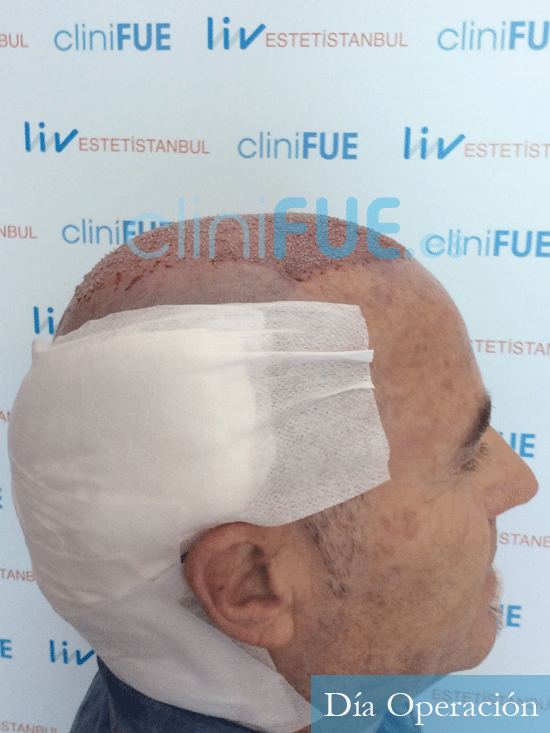 Santos 56 -Navarro trasplante capilar turquia dia operacion 3