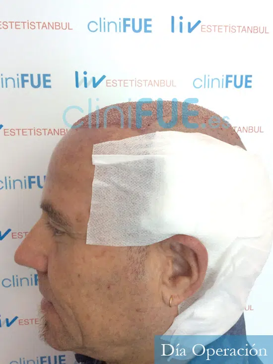 Santos 56 -Navarro trasplante capilar turquia dia operacion 4