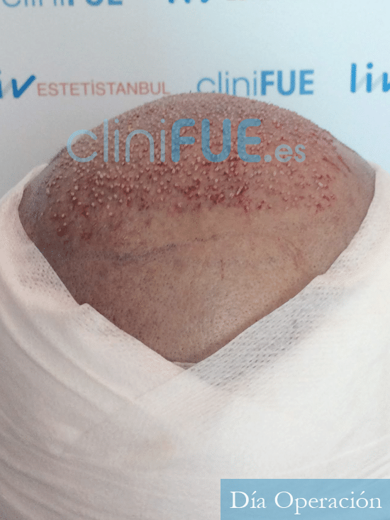 Santos 56 -Navarro trasplante capilar turquia dia operacion 5