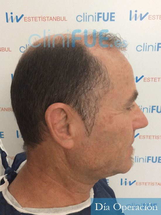 Santos 56 -Navarro trasplante capilar turquia antes 3