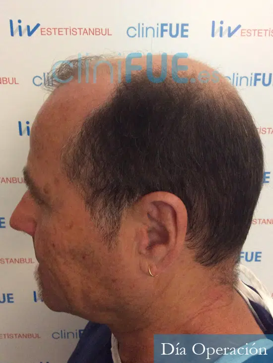 Santos 56 -Navarro trasplante capilar turquia antes 4