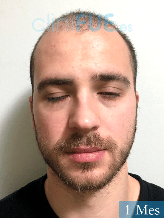 Christian trasplante capilar turquia 1 mes 
