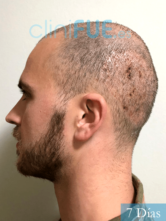 Christian trasplante capilar turquia 7 dias 