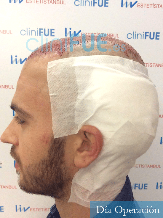 Christian trasplante capilar turquia dia operacion 5