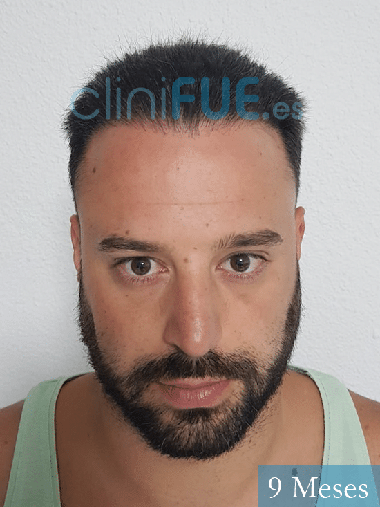 David-31-Alicante-trasplante-capilar-9 meses-