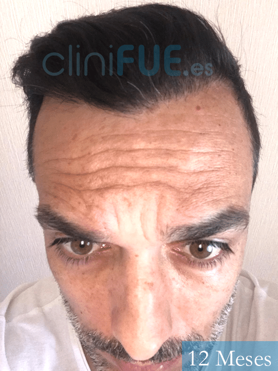 Jose Antonio-43-Murcia-trasplante-capilar-12 meses 
