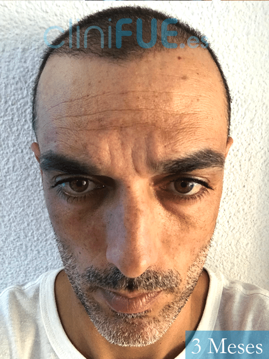 Jose Antonio-43-Murcia-trasplante-capilar-3 meses 