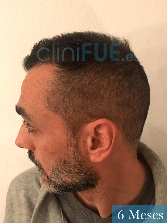 Jose Antonio-43-Murcia-trasplante-capilar-6 meses 