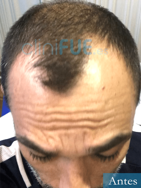 Jose Antonio 43 Murcia trasplante capilar turquia antes 