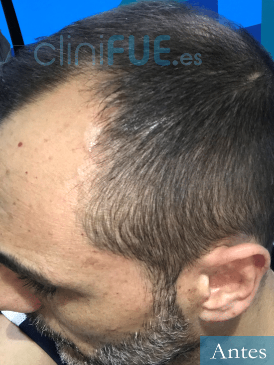 Jose Antonio 43 Murcia trasplante capilar turquia antes 4