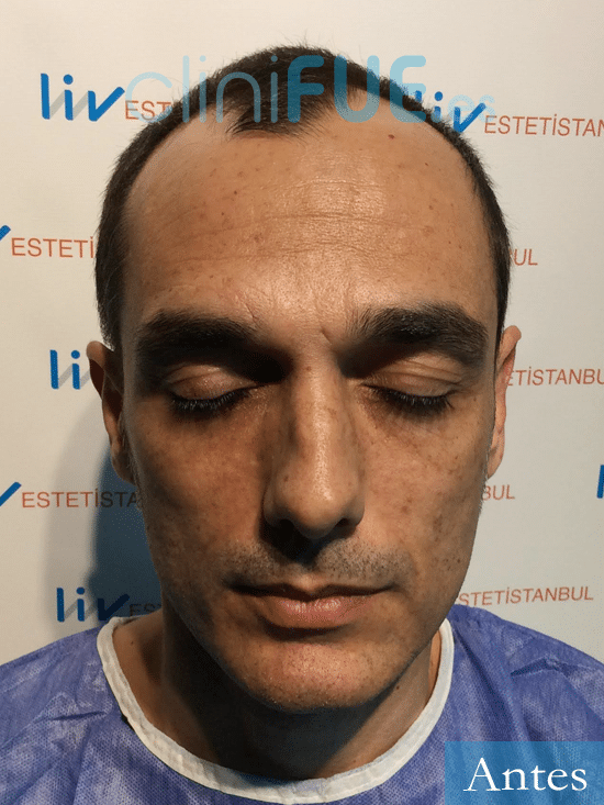 Jose Antonio-43-Murcia-trasplante-capilar-dia operacion-diseno-1