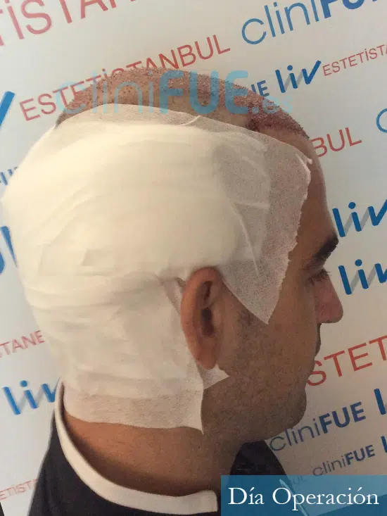 Mario 30 La Roja trasplante capilar turquia dia operacion 