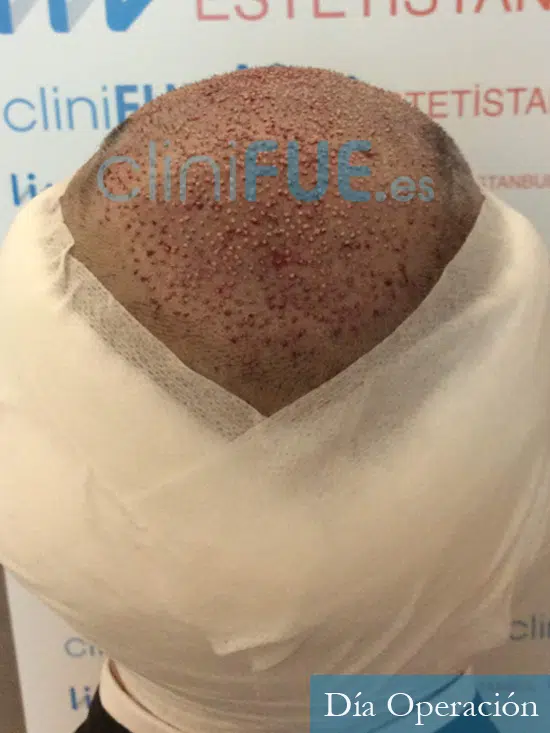 Mario 30 La Roja trasplante capilar turquia dia operacion 