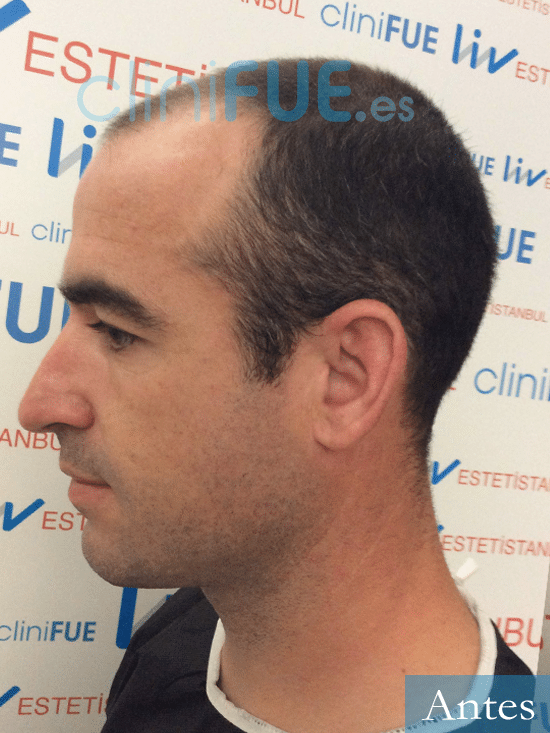 Mario 30 La Roja trasplante capilar turquia dia operacion 3