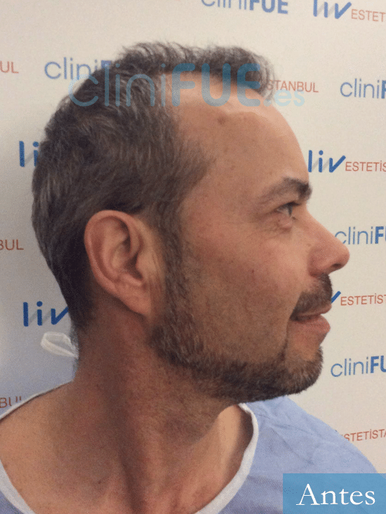 Ramon-Luis-trasplante-capilar-turquia-4 meses-
