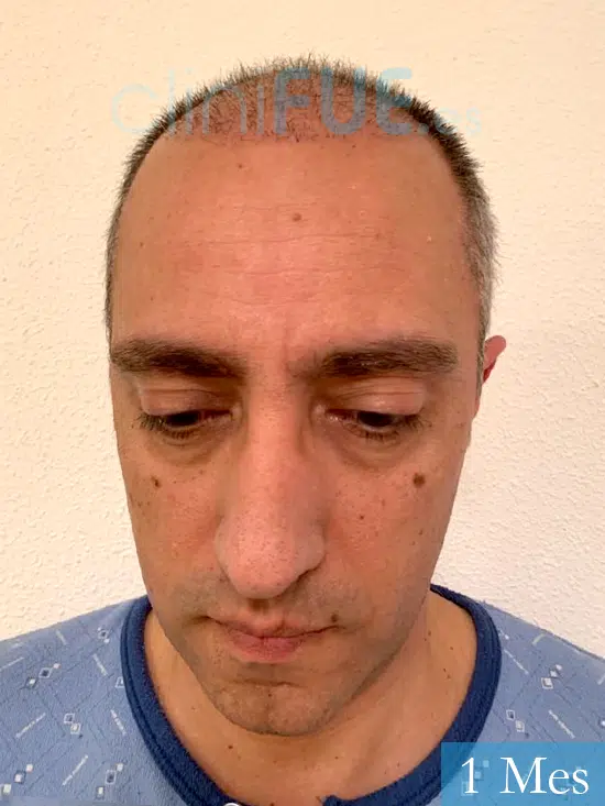 Jose Luis 47 años Vizcaya injerto de pelo 1 mes 