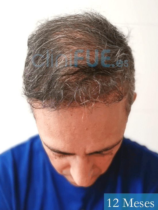 Jose Luis 47 años Vizcaya injerto de pelo 12 meses 
