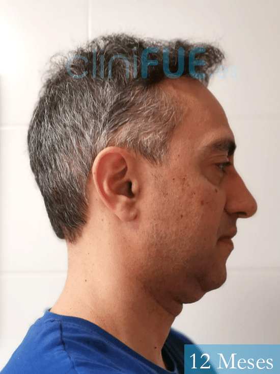 Jose Luis 47 años Vizcaya injerto de pelo 12 meses 