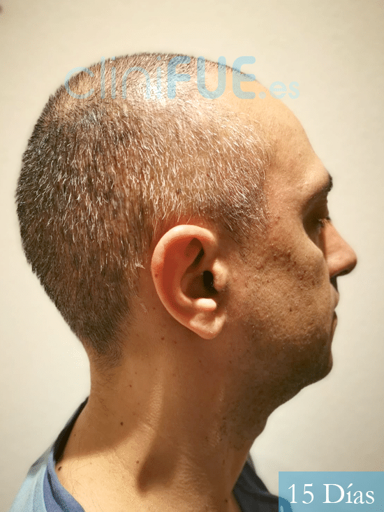 Jose Luis 47 años Vizcaya injerto de pelo 15 dias 