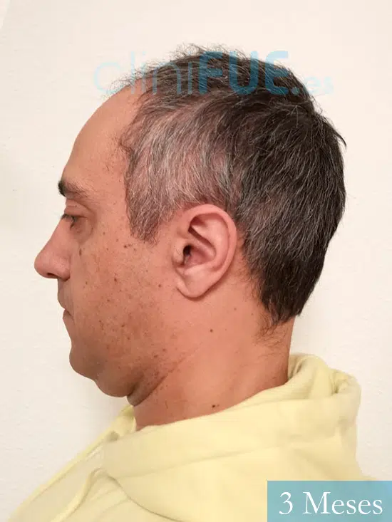 Jose Luis 47 años Vizcaya injerto de pelo 3 meses 