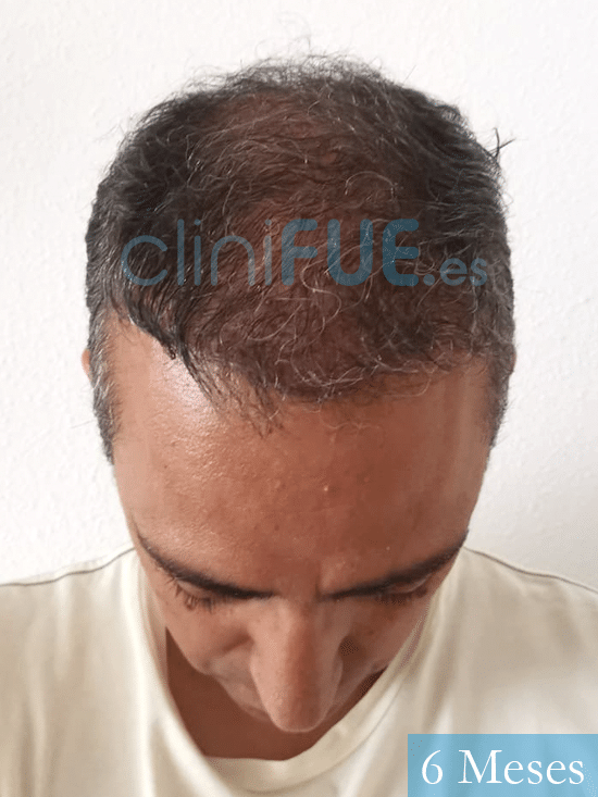 Jose Luis 47 años Vizcaya injerto de pelo 6 meses 