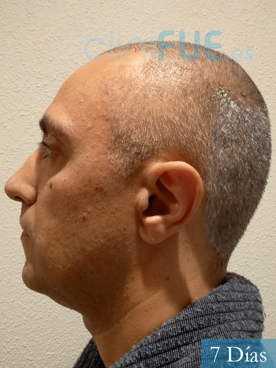 Jose Luis 47 años Vizcaya injerto de pelo 7 dias 