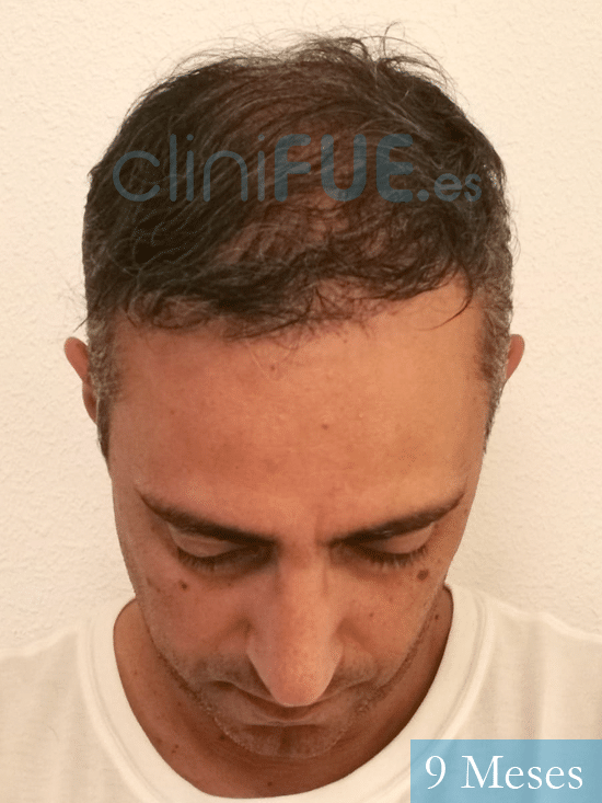 Jose Luis 47 años Vizcaya injerto de pelo 9 meses 