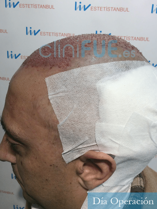 Jose Luis 47 años Vizcaya injerto de pelo dia operacion