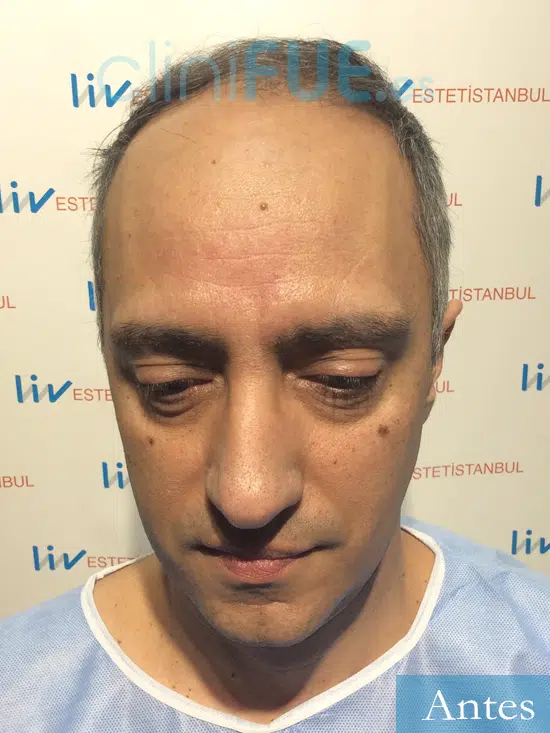 Jose Luis 47 años Vizcaya injerto de pelo dia operacion