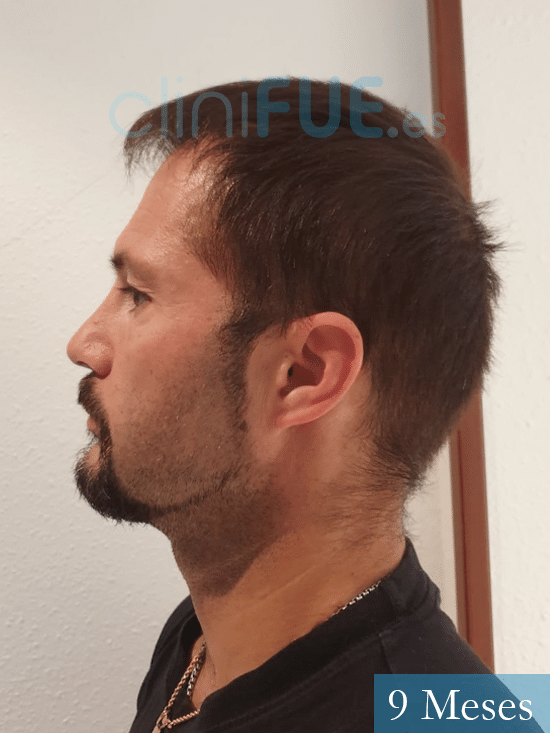 Marco 41 Madrid trasplante capilar turquia 