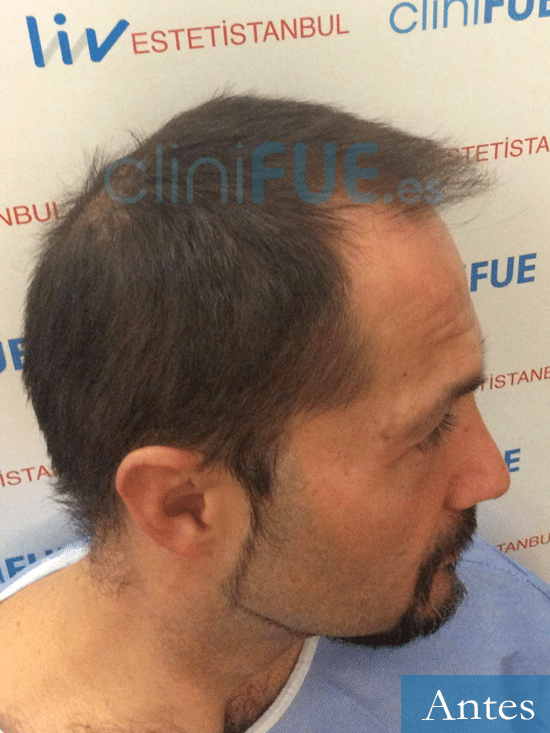 Marco 41 Madrid trasplante capilar turquia antes 