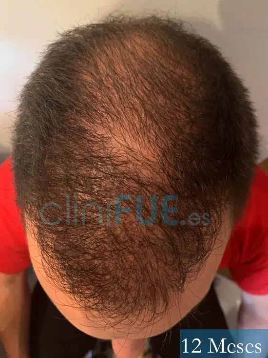 Sergio 31 Madrid trasplante pelo 