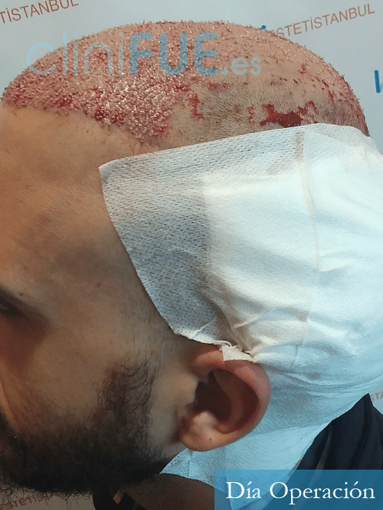 David 32 anos trasplante capilar turquia