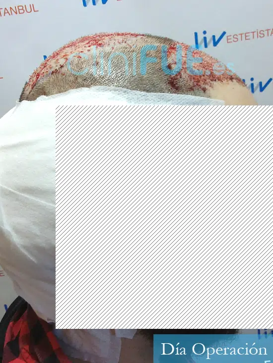 Fran 39 Leon trasplante capilar turquia dia operacion 