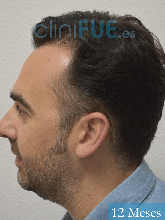 Miguel Angel 40 años Murcia injerto de pelo