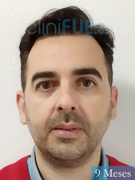 Miguel Angel 40 años Murcia injerto de pelo
