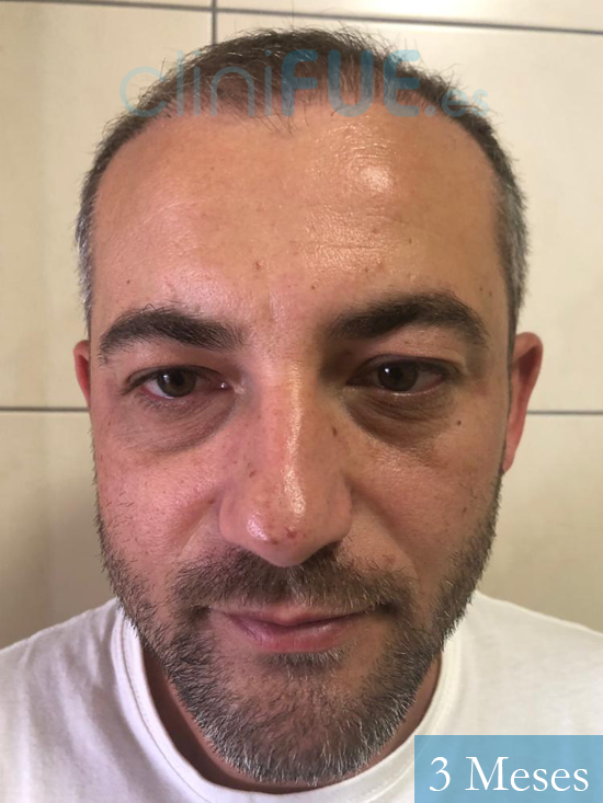 Francesco 36 Arona trasplante capilar turquia antes 