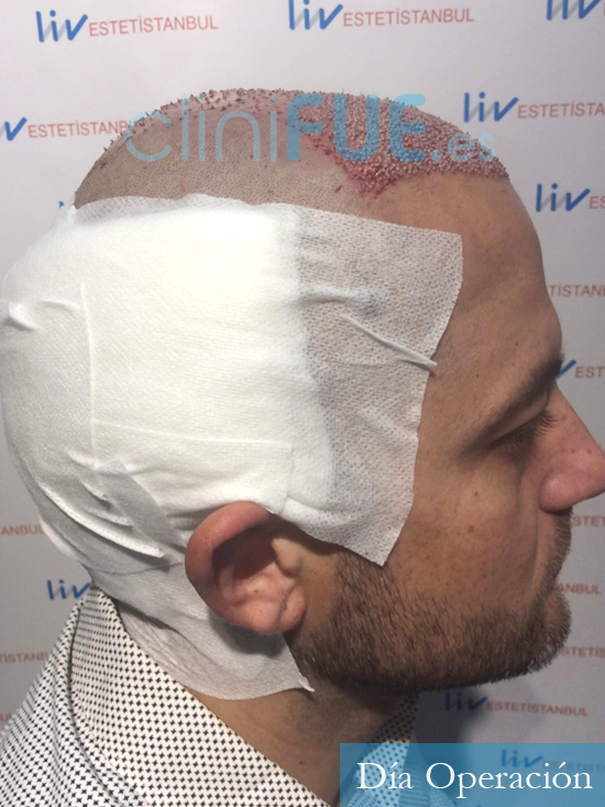 Francesco 36 Arona trasplante capilar turquia antes 