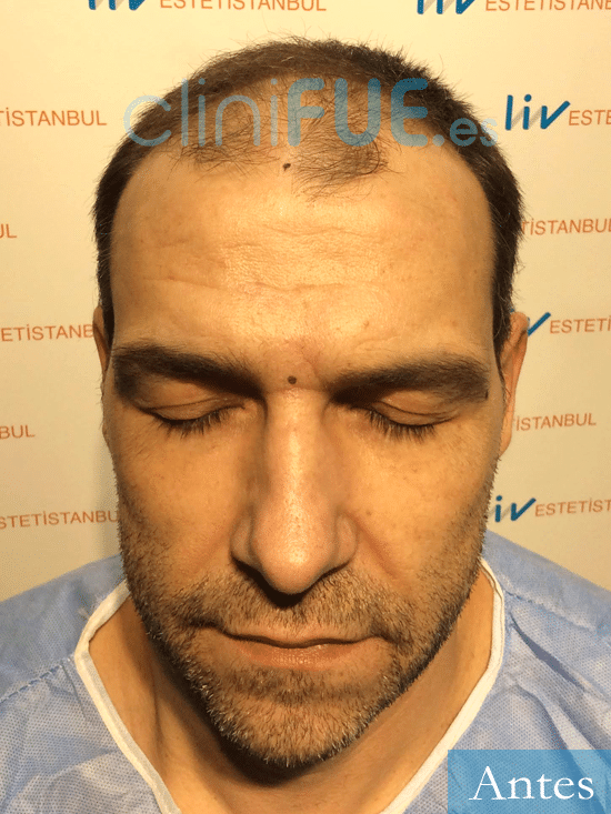 Oscar-44-Pontevedra-trasplante-capilar-turquia-