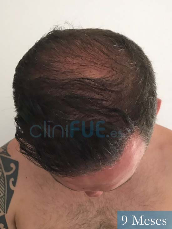 Carlos-30-Palma-trasplante-capilar-turquia- 9 meses 