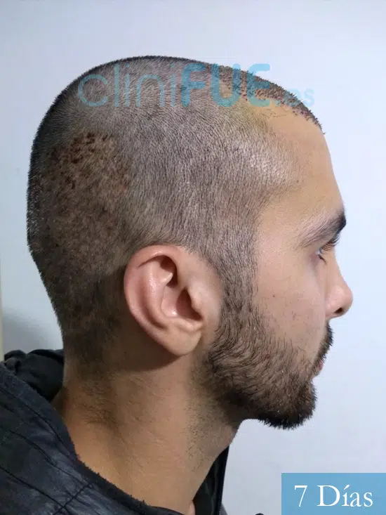 Danny 29 años injerto de pelo dia operacion