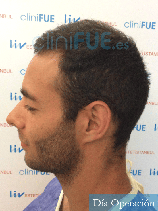 Nasser 31 Grande trasplante capilar turquia antes 